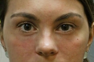 Blepharoplasty Before & After Patient #8896