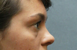 Blepharoplasty Before & After Patient #8896