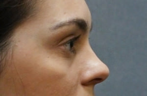 Blepharoplasty Before & After Patient #8896