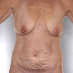 Tummy Tuck Before & After Patient #7925