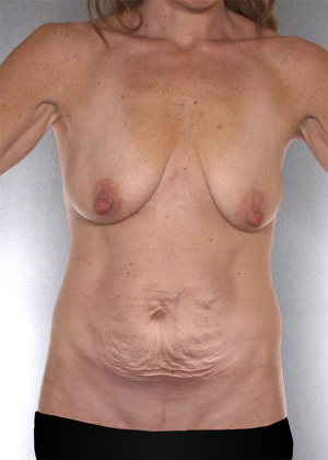 Tummy Tuck Before & After Patient #8064