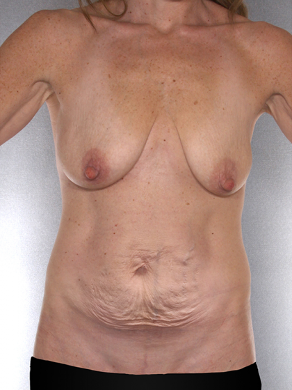 Tummy Tuck Before & After Patient #7925