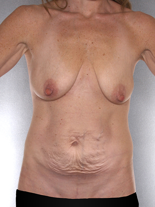 Tummy Tuck Before & After Patient #7925