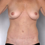 Tummy Tuck Before & After Patient #7925