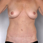 Tummy Tuck Before & After Patient #8064
