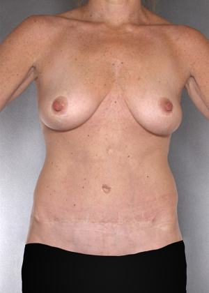 Tummy Tuck Before & After Patient #8064