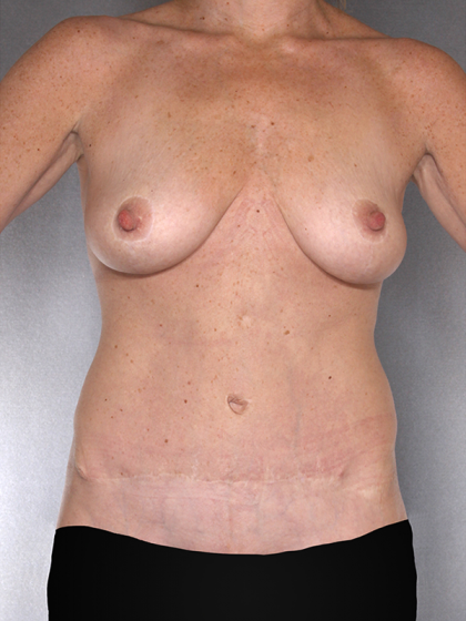 Tummy Tuck Before & After Patient #7925