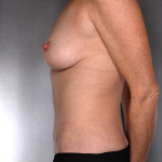 Tummy Tuck Before & After Patient #7925