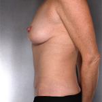 Tummy Tuck Before & After Patient #8064