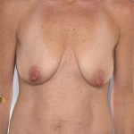 Breast Lift Before & After Patient #8213