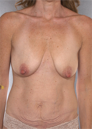 Breast Lift Before & After Patient #8213