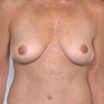 Breast Lift Before & After Patient #8213