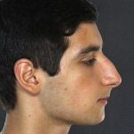 Rhinoplasty Before & After Patient #9062