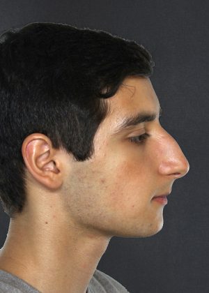 Rhinoplasty Before & After Patient #9062