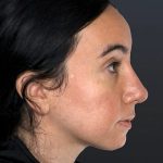 Rhinoplasty Before & After Patient #9067