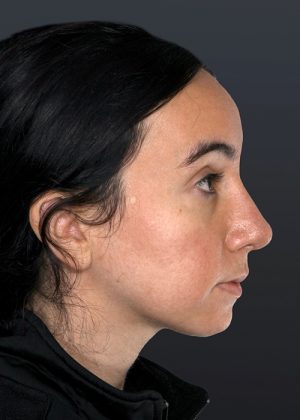 Rhinoplasty Before & After Patient #9067