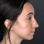Rhinoplasty Before & After Patient #9067
