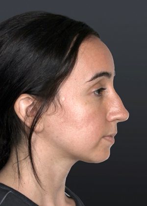 Rhinoplasty Before & After Patient #9067