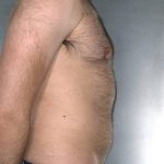 Liposuction Before & After Patient #8774