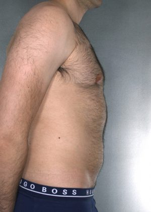 Liposuction Before & After Patient #8774
