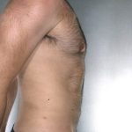 Liposuction Before & After Patient #8774