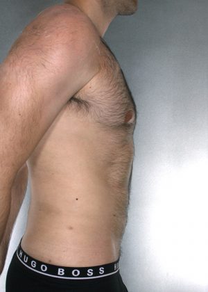 Liposuction Before & After Patient #8774