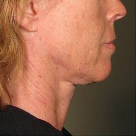 Ultherapy Before & After Patient #9353