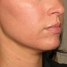 Ultherapy Before & After Patient #9357