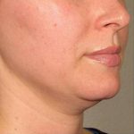 Ultherapy Before & After Patient #9357