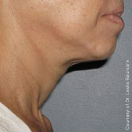 Ultherapy Before & After Patient #9360