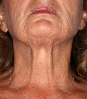 Ultherapy Before & After Patient #9363