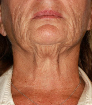 Ultherapy Before & After Patient #9363