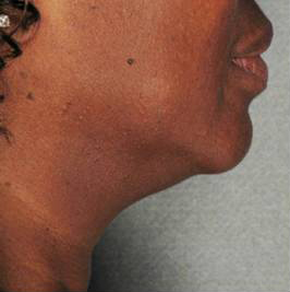 Ultherapy Before & After Patient #9366