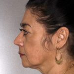 Facelift Before & After Patient #9334
