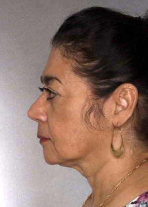 Facelift Before & After Patient #9334