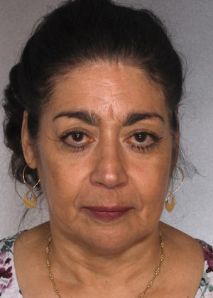 Facelift Before & After Patient #9334