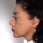 Facelift Before & After Patient #9334