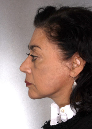 Facelift Before & After Patient #9334