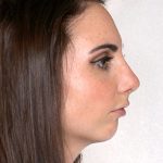 Rhinoplasty Before & After Patient #9072