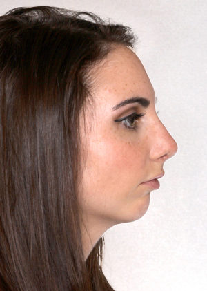 Rhinoplasty Before & After Patient #9072