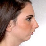 Rhinoplasty Before & After Patient #9072