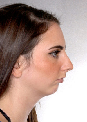Rhinoplasty Before & After Patient #9072