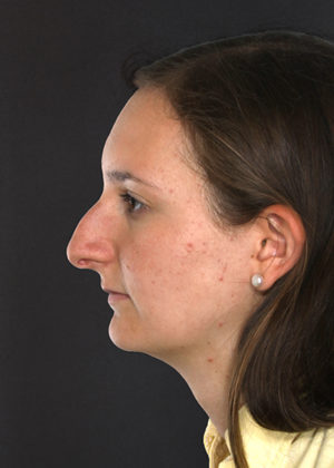 Rhinoplasty Before & After Patient #9077