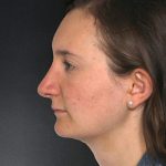 Rhinoplasty Before & After Patient #9077