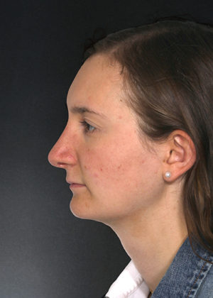 Rhinoplasty Before & After Patient #9077