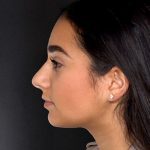 Rhinoplasty Before & After Patient #9082