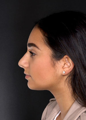 Rhinoplasty Before & After Patient #9082