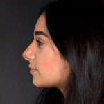 Rhinoplasty Before & After Patient #9082