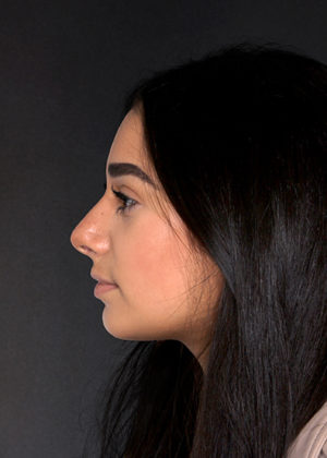 Rhinoplasty Before & After Patient #9082