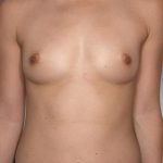 Breast Augmentation Before & After Patient #8196